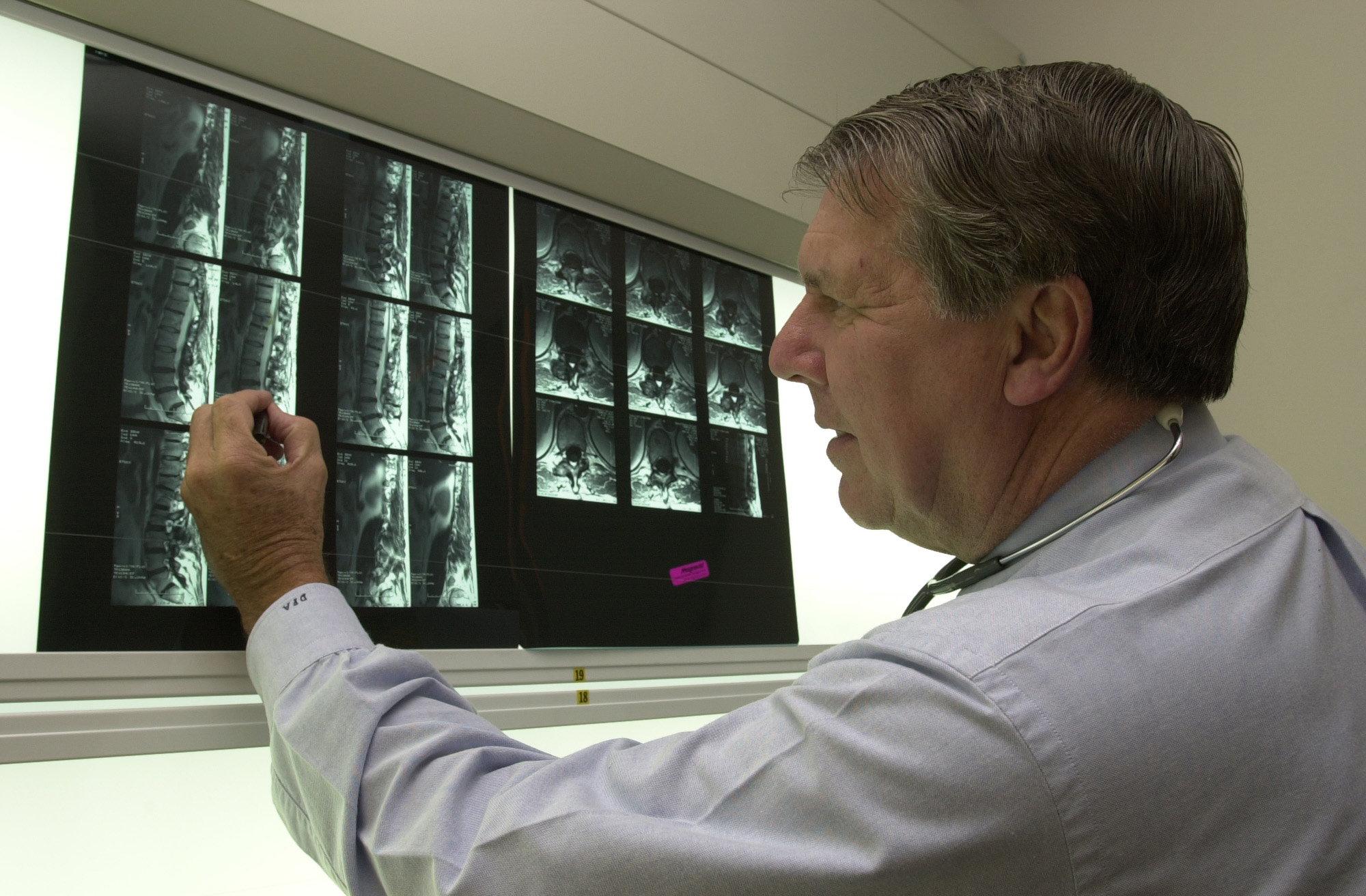 Dr. Apple examines multiple spinal X-ray images displayed on a lightbox, using a pen to point at details. He is wearing a light shirt and has a stethoscope around his neck.